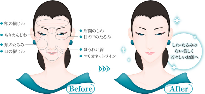 しわ・たるみの治療箇所